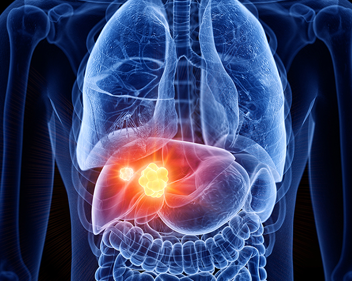 Liver Cancer - Dr. ReshmaPuranik