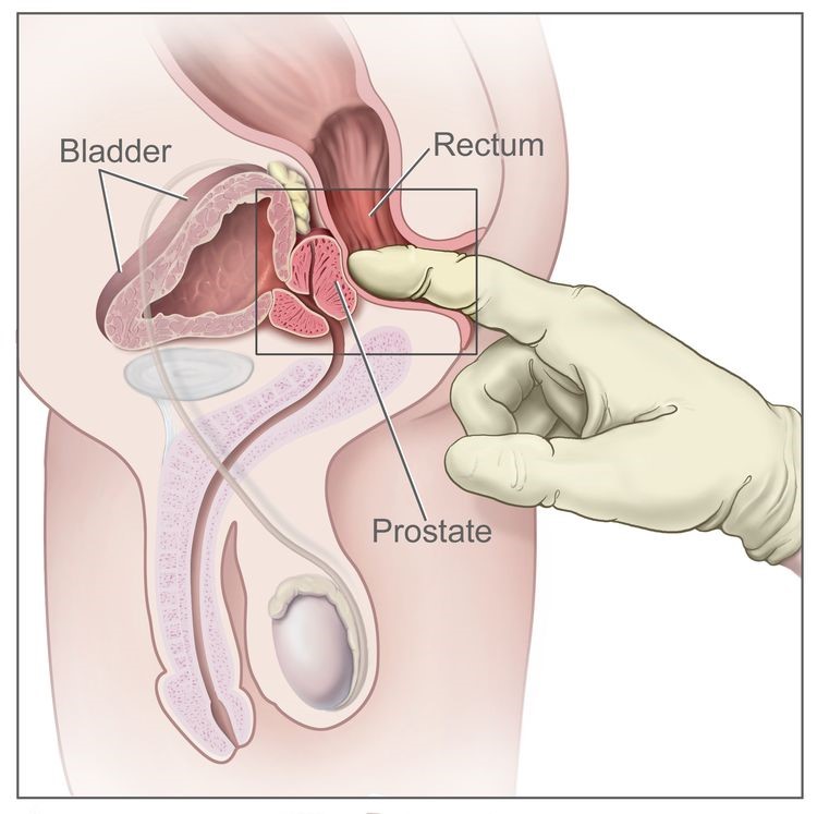 Best Prostate Cancer Specialist in Pune